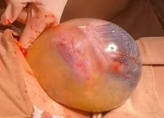 Jovem de 24 anos dá à luz bebê empelicado em Irecê: 'surpresa enorme'
