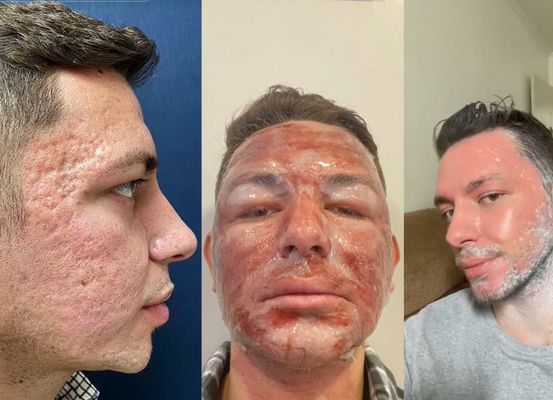 Caso Henrique Chagas e Peeling de fenol: veja o que é, como funciona e quais os riscos